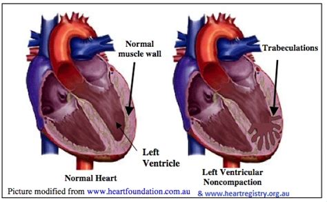 what is lv noncompaction.